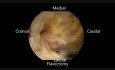 Biportal Endoscopic Spinal Surgery (Arthroscopic TLIF by 30 Degree Arthroscopy)