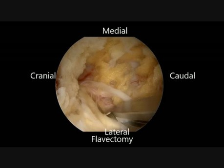 Biportal Endoscopic Spinal Surgery (Arthroscopic TLIF by 30 Degree Arthroscopy)