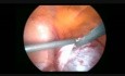 Laparoscopic Cystectomy Due to Cystadenoma