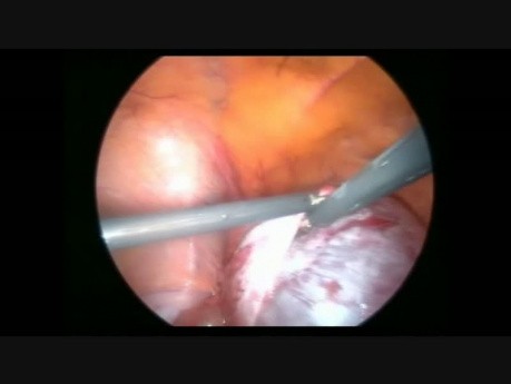 Laparoscopic Cystectomy Due to Cystadenoma
