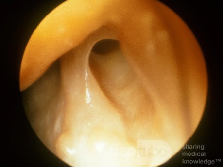 The Nasolacrimal Duct