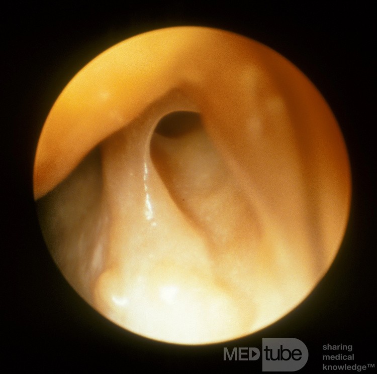 The Nasolacrimal Duct