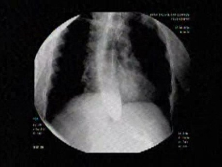 Esophageal Achalasia - Appearance of the Esophagus