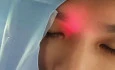 Frontal Sinus Illumination Using Baloon Sinuplasty Light Guide