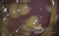 Endoscopic appearance of the Pseudomembranous colitis