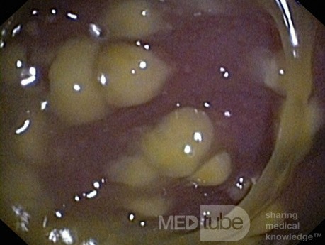 Endoscopic appearance of the Pseudomembranous colitis