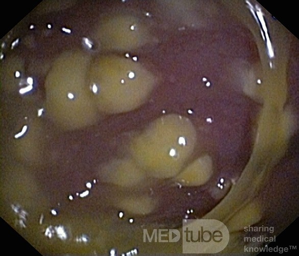 Endoscopic appearance of the Pseudomembranous colitis
