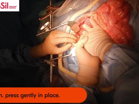 TachoSil For Sufficient Haemostasis and Sealing During Liver Fragment Transplantation in a 4-year-old Patient