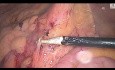 Laparoscopic Left Hemicolectomy for Sigmoid Cancer: Stepwise Approach