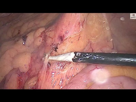 Laparoscopic Left Hemicolectomy for Sigmoid Cancer: Stepwise Approach