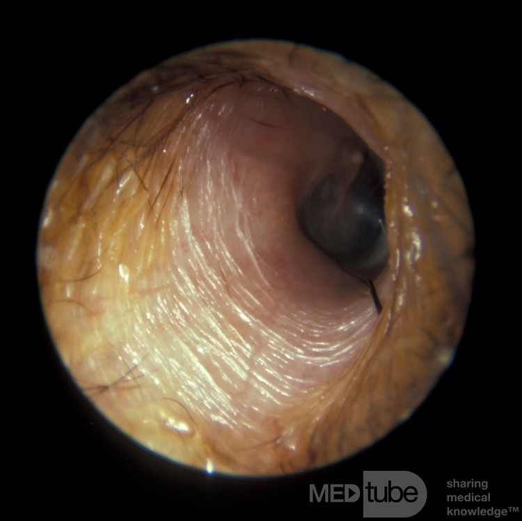 Horizontal Wrinkles of the Deep Canal Epithelium