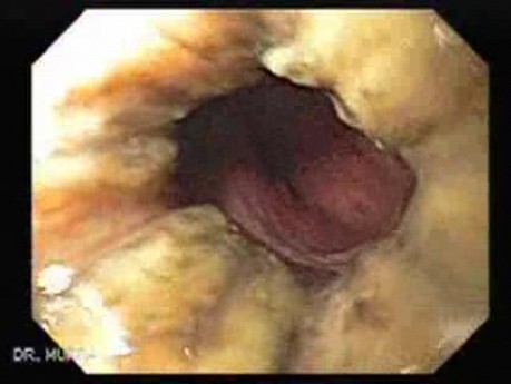 The Black Esophagus - Assessment of Esophageal Mucosa, Part 2
