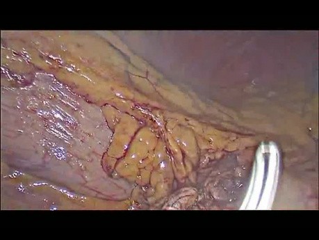 Laparoscopic left splenopancreatectomy