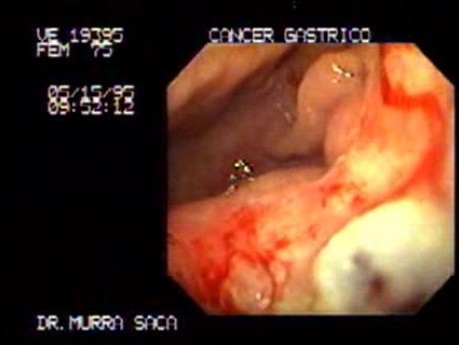 Adenocarcinoma of the Corpus and Fundus