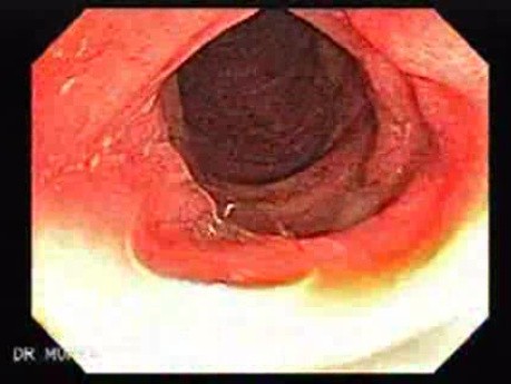 Colitis Ulcerosa - Pseudopolyps (11 of 22)