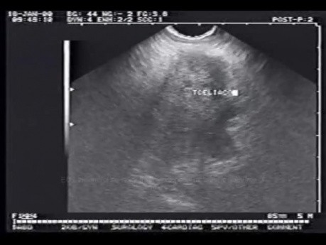 EUS-FNA of pancreatic cancer