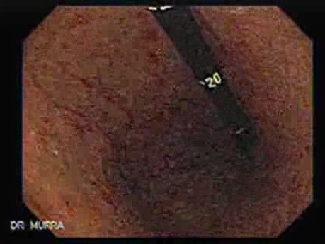 Duodenal Ulcers (4 of 4)