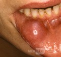 Large Mucocoele Lip