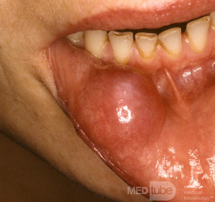 Large Mucocoele Lip