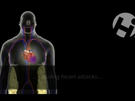 Atherosclerosis