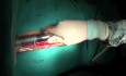 Median Sternotomy - Cardiac Surgery