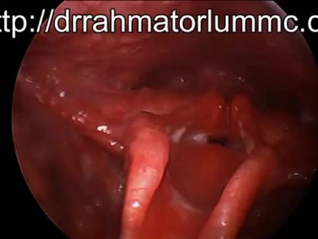 Supraglottic Stenosis (Narrowed Voice Box) as an Effect of Motor Vehicle Accident