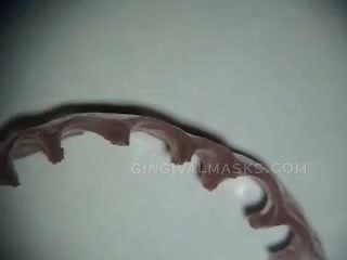 Missing Papillae Reconstruction