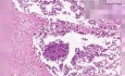 Small Cell Carcioma - Histopathology - Lung