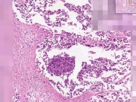 Small Cell Carcioma - Histopathology - Lung