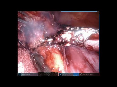 Mediastinal Teratoma (Robotic Surgery)