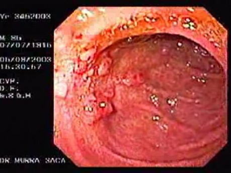 Duodenal Ulcers and Erosions (3 of 3)
