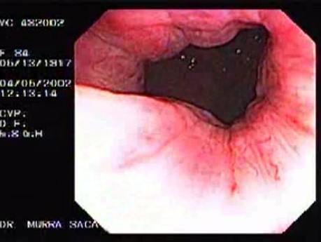 Rectal Adenocarcinoma - 84 Year - Old Woman