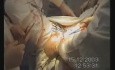 Rectum Cancer Surgery