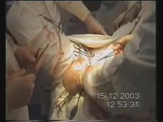 Rectum Cancer Surgery