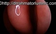 Perforation of A Nasal Septum [Hole in The Nasal Cavity Partition] in HD