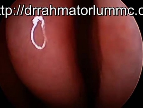 Perforation of A Nasal Septum [Hole in The Nasal Cavity Partition] in HD
