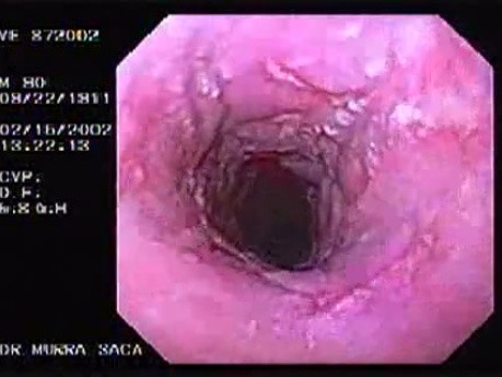 Barrett´s Esophagus (3 of 4)
