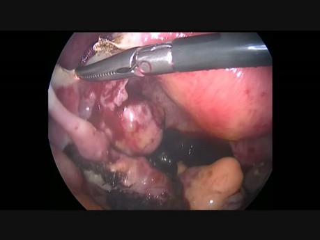 Ectopic Pregnancy