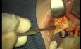 Rebuild Of Madnibular Implant Site (1/4)