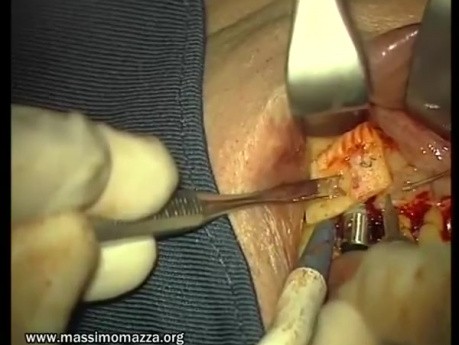 Rebuild Of Madnibular Implant Site (1/4)