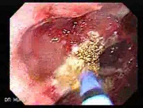 Multiple Adenomatous Polyps Of The Rectum (21 of 37)