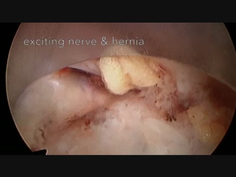 Full-Endoscopic Extraforaminal Approach to the Lumbar Spine for Discectomy 