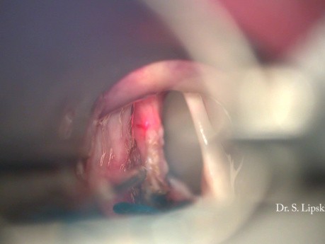 Surgical Revicion of a Vocal Cord Cancer