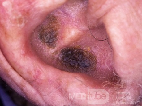 Neglect Keratosis