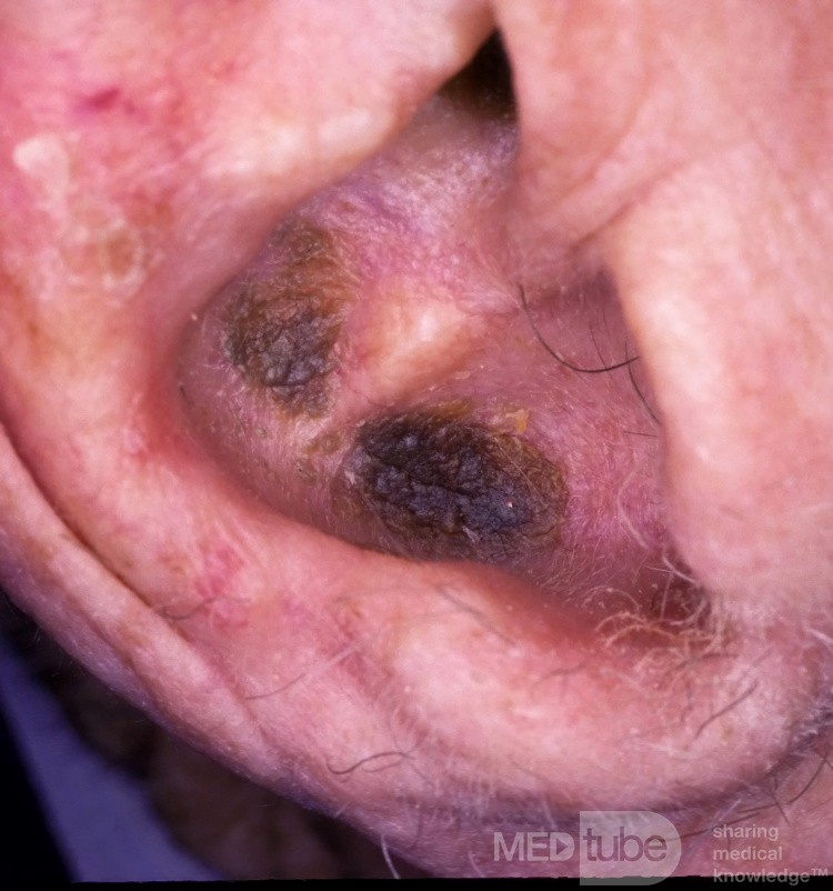 Neglect Keratosis