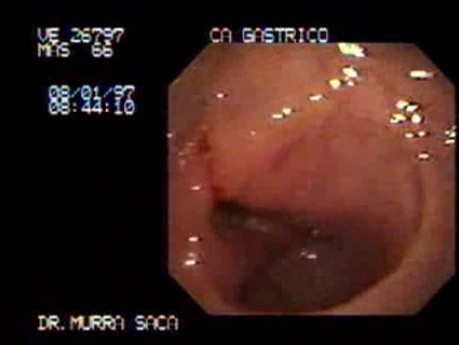 Gastric Adenocarcinoma - Obstruction - Endoscopy