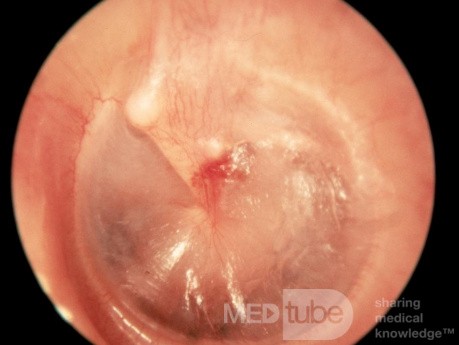 Hematoma Tympanic Membrane