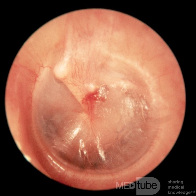 Hematoma Tympanic Membrane