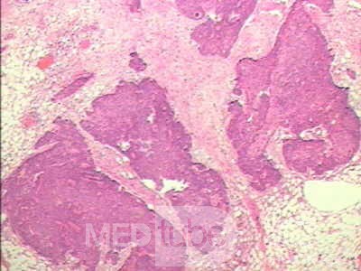 Perforation of a Esophageal Carcinoma after the procedure
 with hydrostatic balloon dilation (10 of 12)