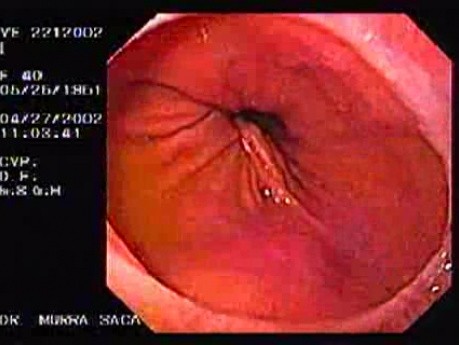 Hiatus Hernia with Schatzki Ring